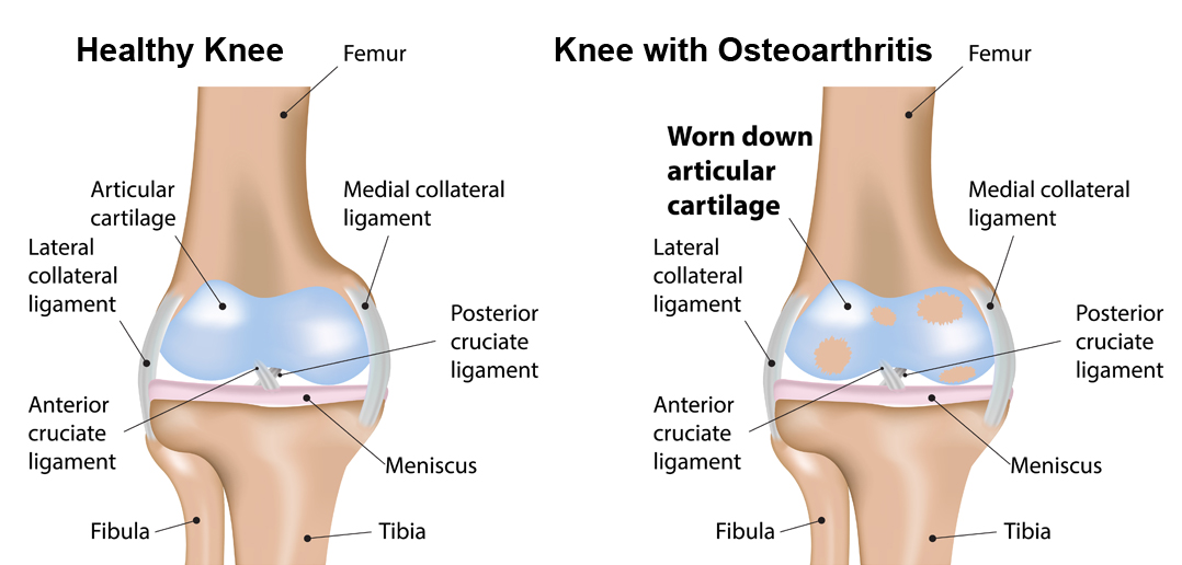 Osteoarthritis
